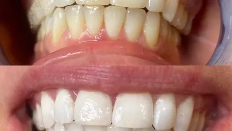 Antes y después de un tratamiento estético dental